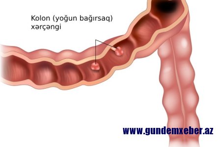 Bu qidalar bağırsaq xərçənginə səbəb olur -ADLAR